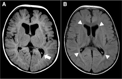 Case report: Suspecting guanine nucleotide-binding protein beta 1 mutation in dyskinetic cerebral palsy is important